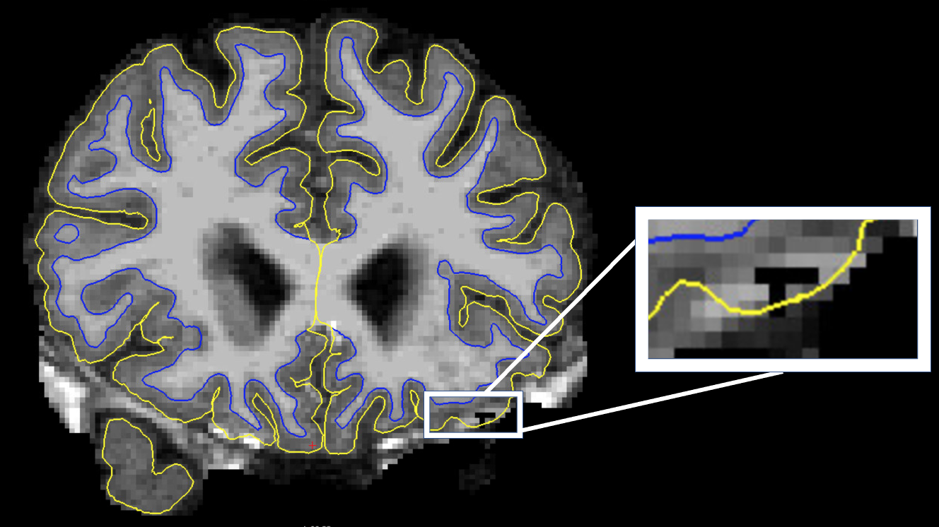 Pial surface includes non-grey matter
